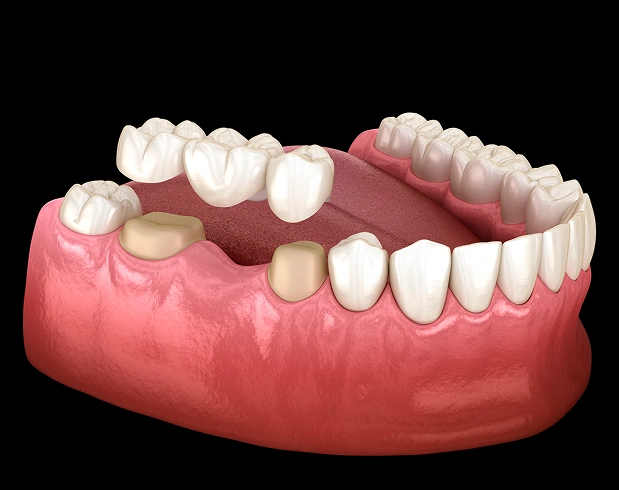 Dental Bridges