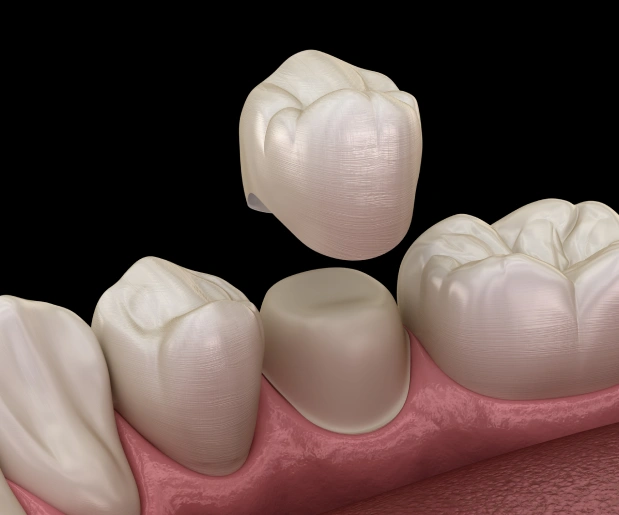 Dental Crowns