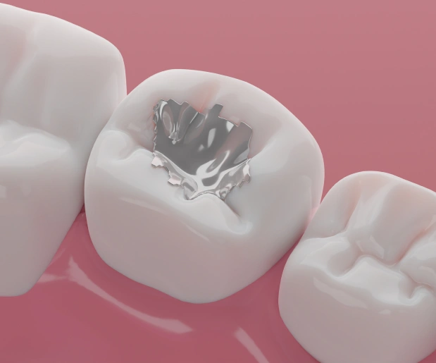 Dental Fillings