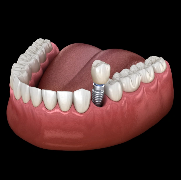 Dental Implants